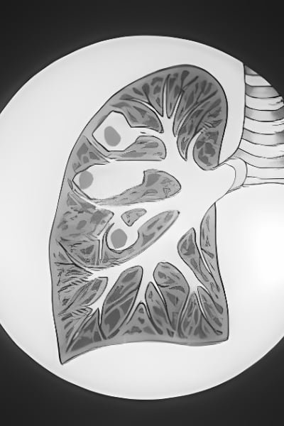 Preventing Tuberculosis